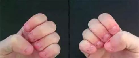 13岁女儿啃指甲,孩子啃烂指甲修复