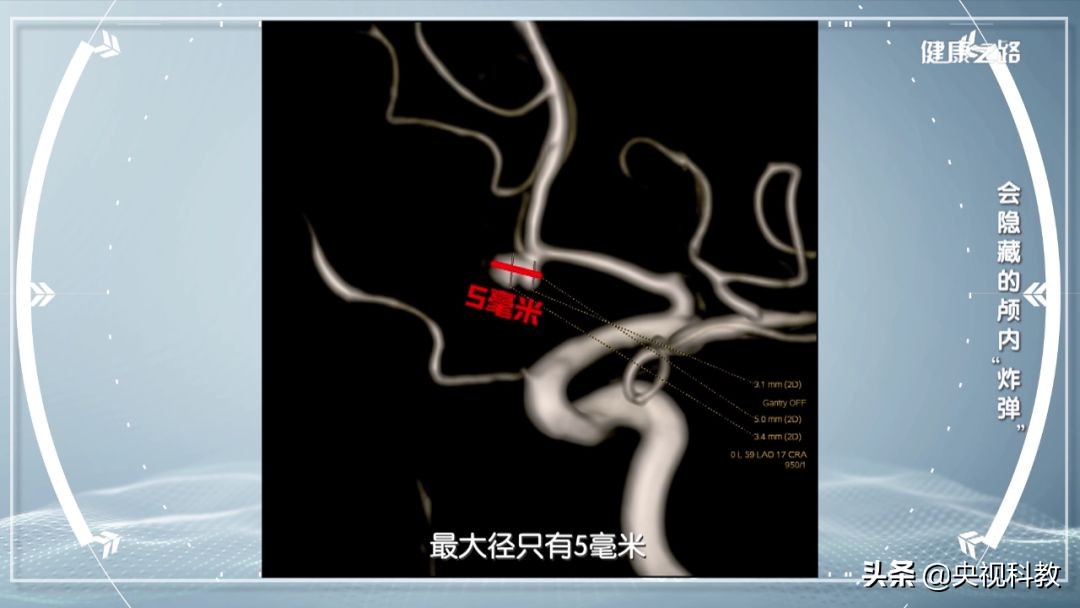 脑动脉瘤能吃腌制食品吗,过度食用腌制食品