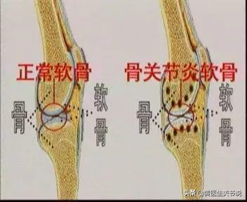 导致膝关节疼痛的原因有很多，防治方法有哪些？