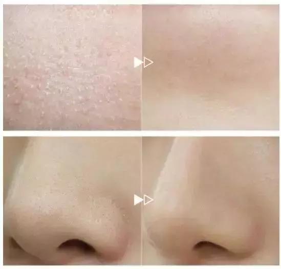 鼻子黑头清洁面膜哪个牌子好,哪种清洁面膜祛黑头粉刺有效果