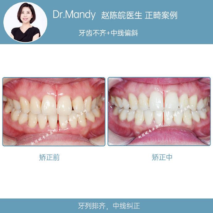正畸牙齿不齐案例,牙齿拥挤正畸真实案例