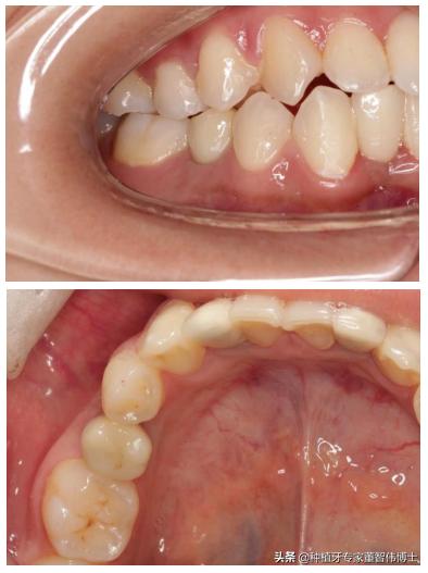 拔牙后即刻种植好还是延期种植好,拔牙后牙槽骨突的修复术视频