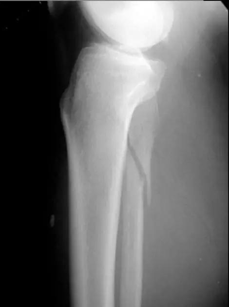 所有骨折都叫什么名字,骨折的名称有哪些