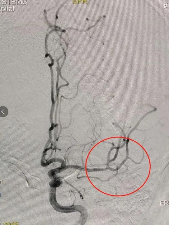 突发右侧偏瘫失语一个月,偏瘫突然失语