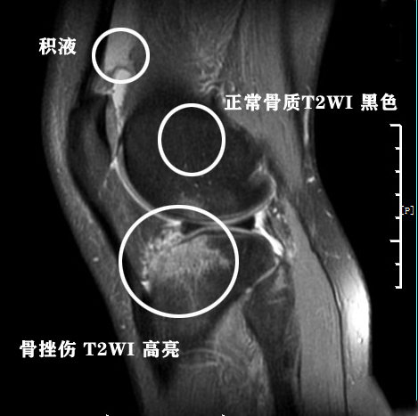 膝关节核磁共振报告单上怎么看,膝关节核磁正常报告单