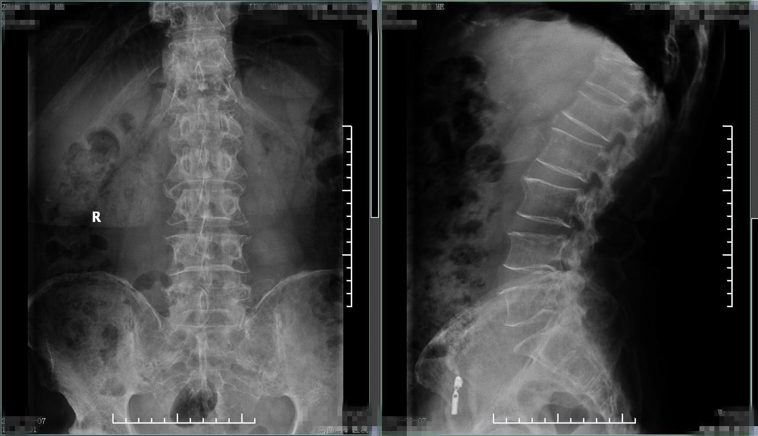老年人腰腿痛不要忽视,中老年人腰背部酸痛