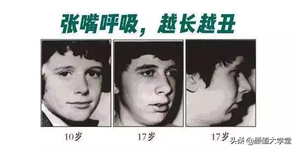 下巴后缩怎么拍侧颜,下巴后缩需要怎么矫正