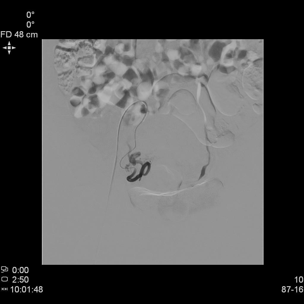 子宫肌瘤不能开刀只能化疗严重吗,子宫肌瘤介入栓塞治疗后注意事项