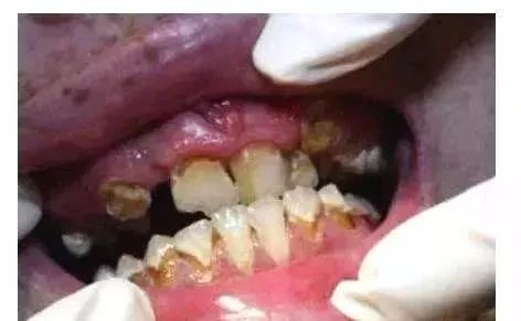 毒牙吸食者的特征,毒冰块中毒症状