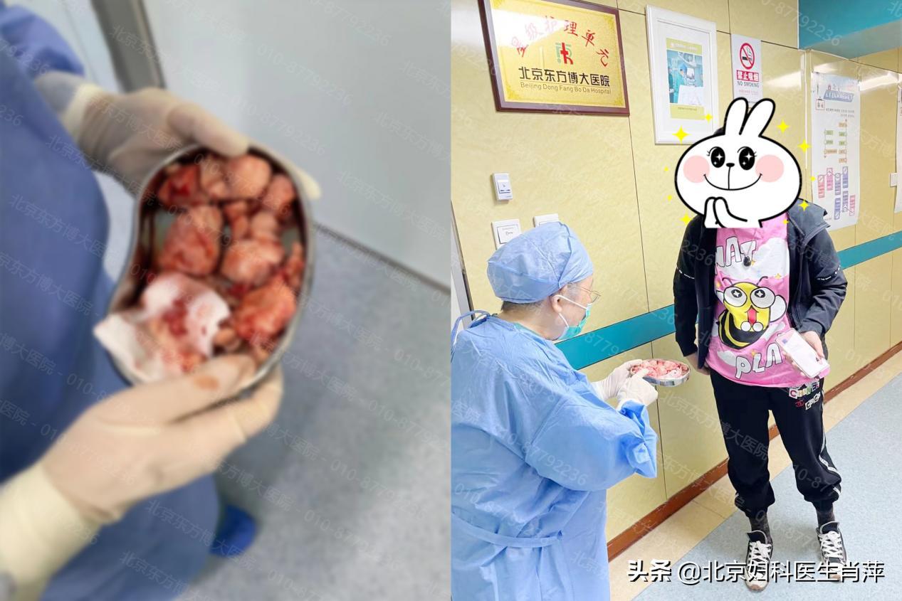 腺肌症手术保宫治疗需要注意什么,腺肌症调理