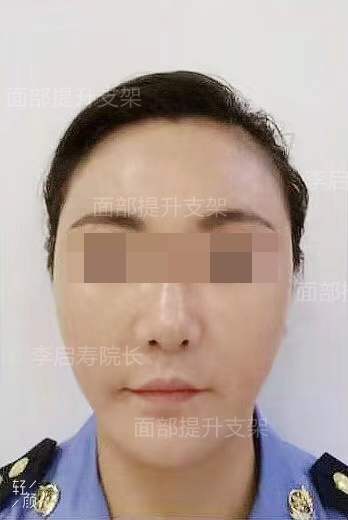 40岁做了线雕的前后图片,40岁以上法令纹下垂医美