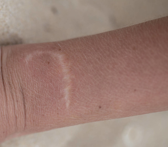 伤口增生是怎么引起的--怎么避免伤口增生？