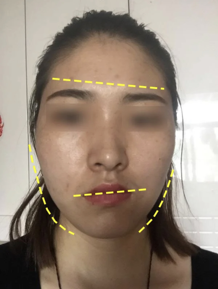 大小脸影响大吗,大小脸能不能改善