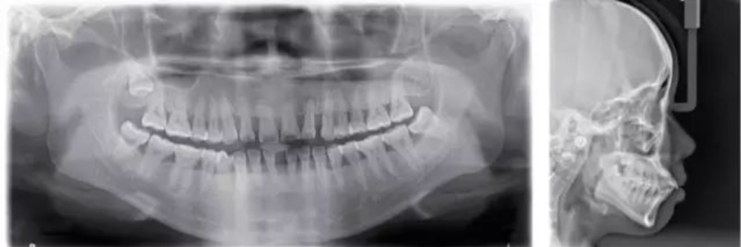 正畸初诊治疗需要验血吗,正畸初诊到戴牙套多久