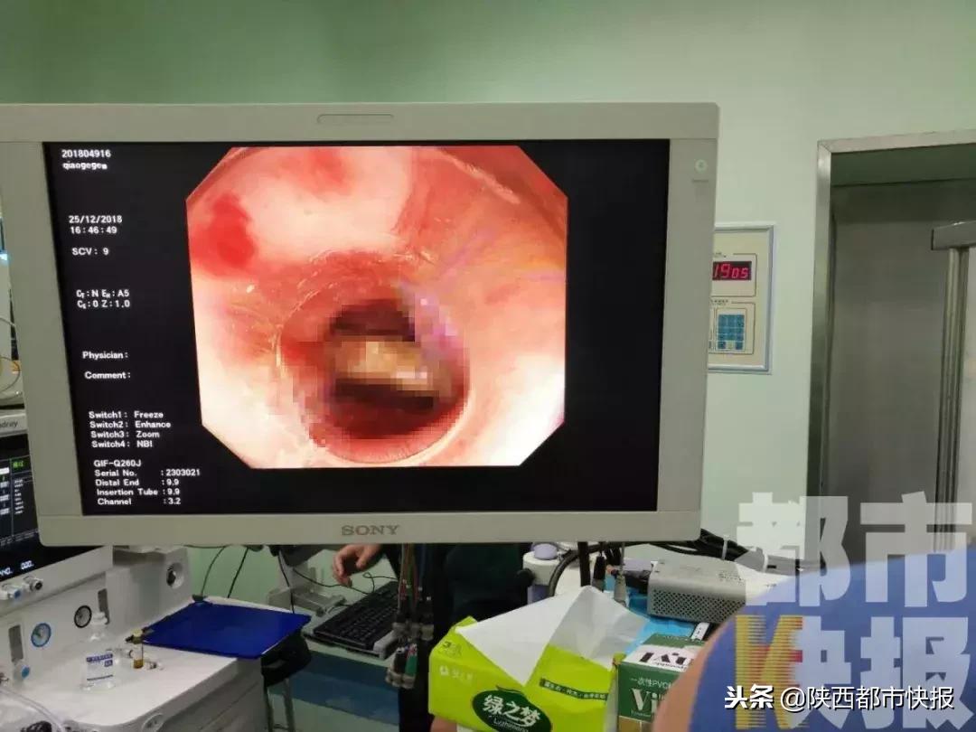 孕妇吃枣把枣核吞下去了没事吧,孕妇吃红枣不小心把核吞了