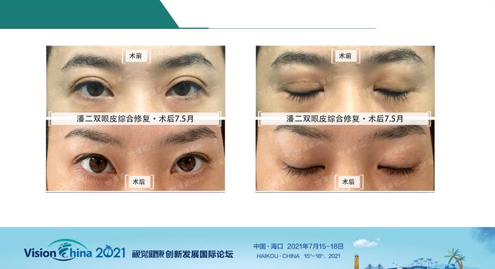潘贰眼博士双眼皮原理,潘贰眼部整形案例