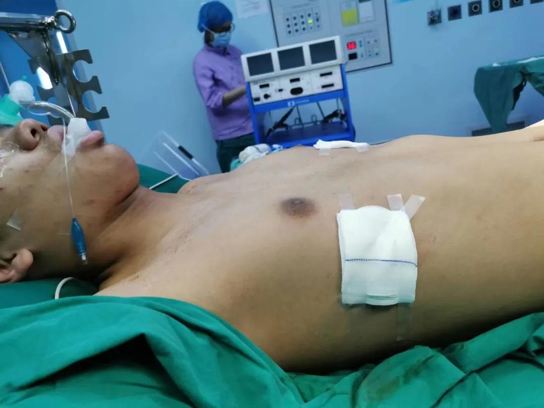 胸前肋骨两侧凹陷属于漏斗胸吗,胸口凹陷一个小坑一定是漏斗胸吗