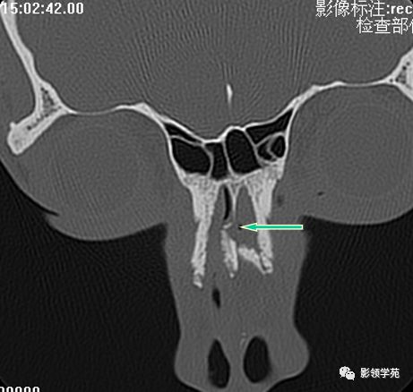 鼻骨影像学解剖,鼻骨解剖及骨折影像学诊断