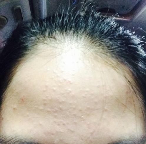 闭口痘痘怎么正确消除,闭口痘痘的正确消除方法