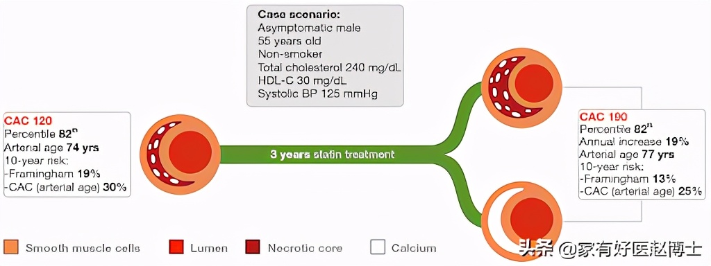 体检显示部分脑动脉钙化,体检显示冠状动脉钙化要紧吗