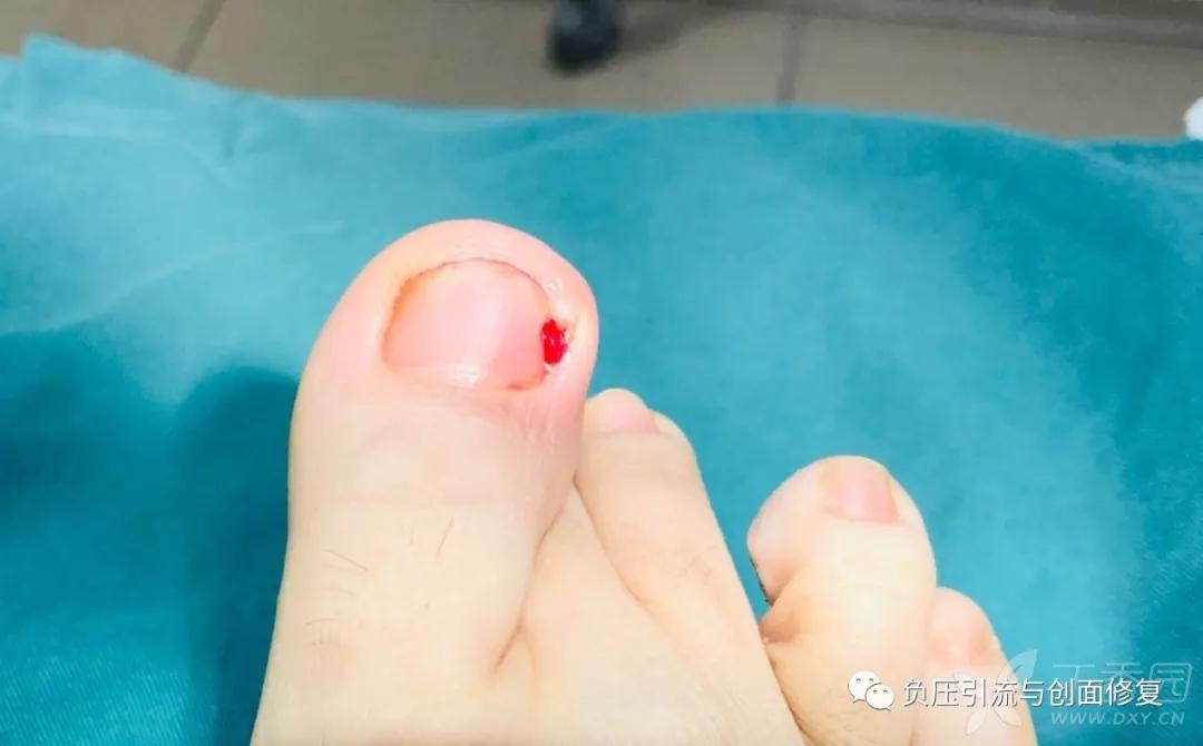 自己剪掉甲沟炎肉芽自己会消掉吗,甲沟炎拔甲后复发的几率多大