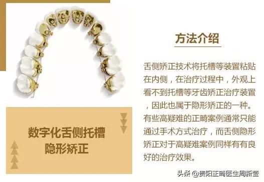 变美干货分享轻医美,矫正牙齿小干货