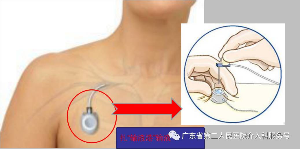 输液港能多次做吗,输液港可以重复使用吗