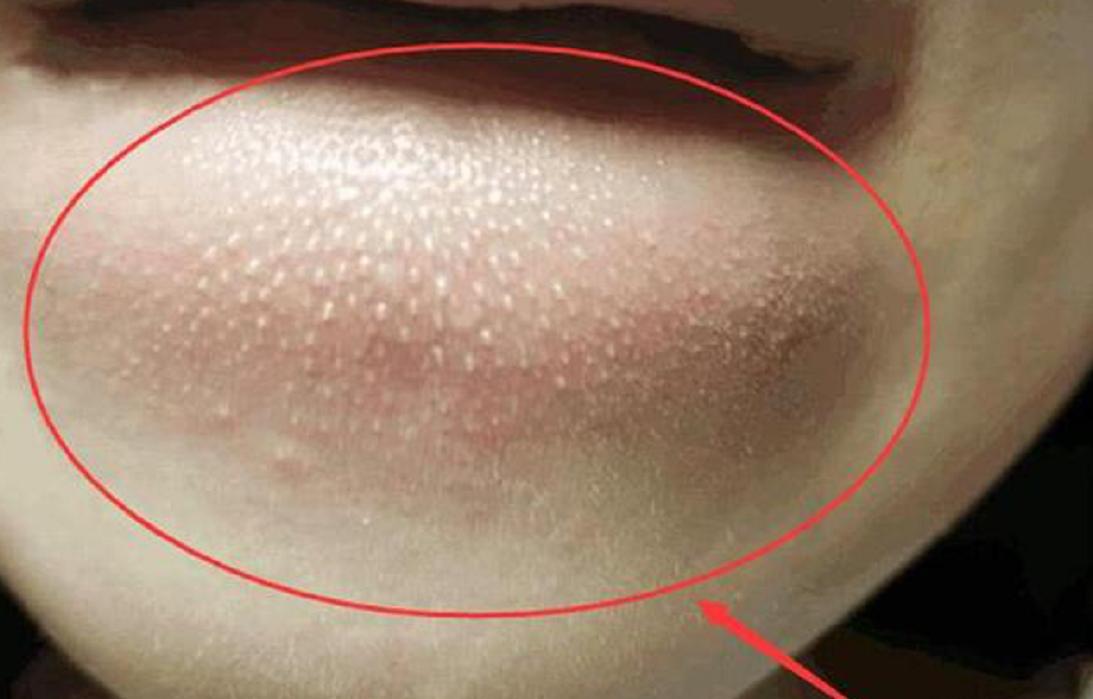 下巴长小小的白色颗粒状疙瘩,七岁小孩下巴有白色小疙瘩