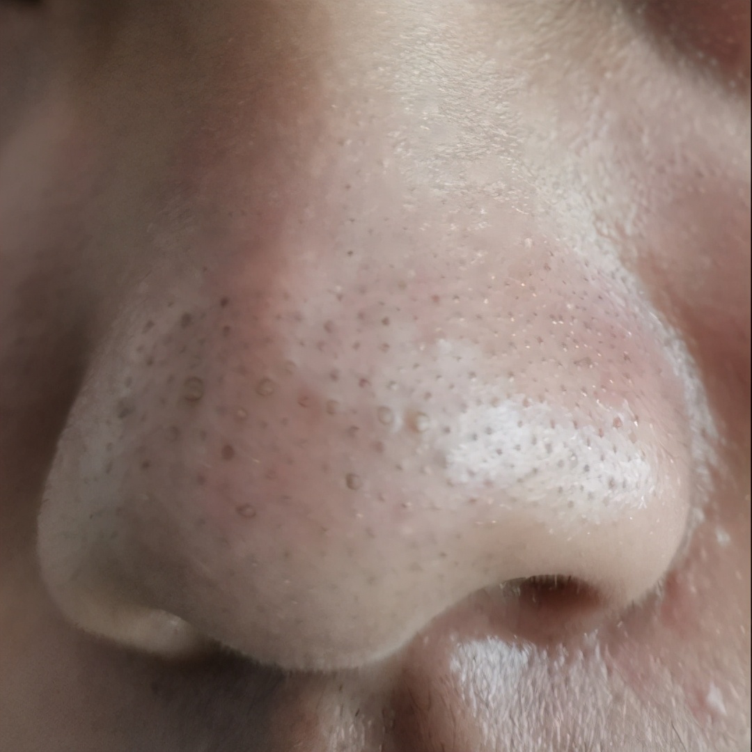 黑头如果不管的话会怎样,如果不清理黑头会怎样