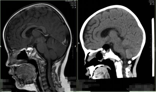 母女同患脑肿瘤，难道肿瘤也会遗传？