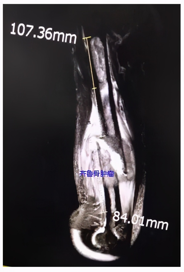 山东齐鲁医院青岛院区射频消融术,齐鲁医院等离子消融术