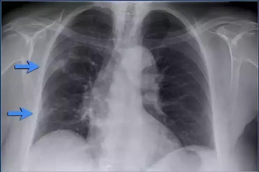 儿童胸片肺实变怎么看,胸病的症状有哪些表现