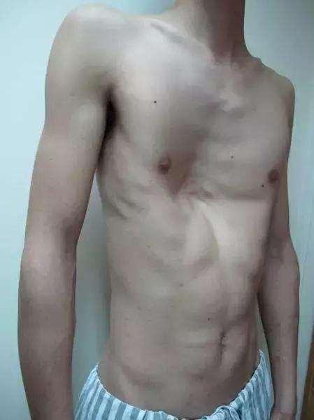 「拿掉」胸上的「漏斗」，让这个孩子挺起胸膛