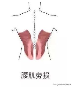 超详细的腰痛康复方案——腰痛自我评估、手法理疗和康复训练全解