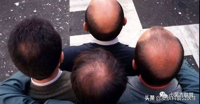 脱发严重但是头发还是很浓密,脱发头发油腻怎么办