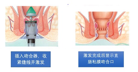 严重的痔疮用传统还是微创,生痔疮用什么药好呢