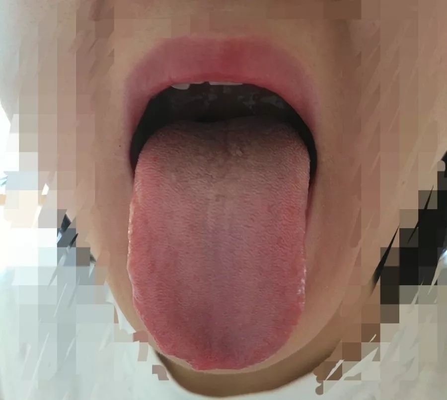 疏肝达郁法治崩漏，10年没断过的“大姨妈”终于恢复正常了