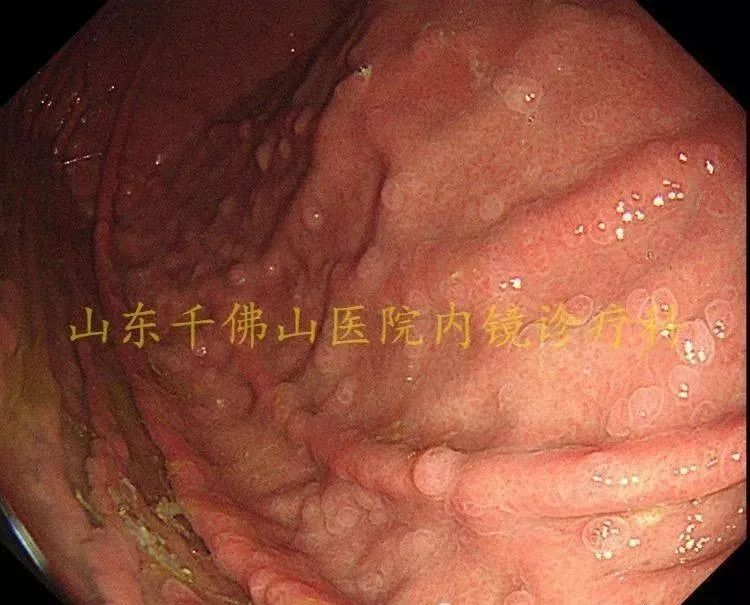 嘴唇黑斑是黑斑息肉综合症吗,黑斑息肉病建议要孩子吗