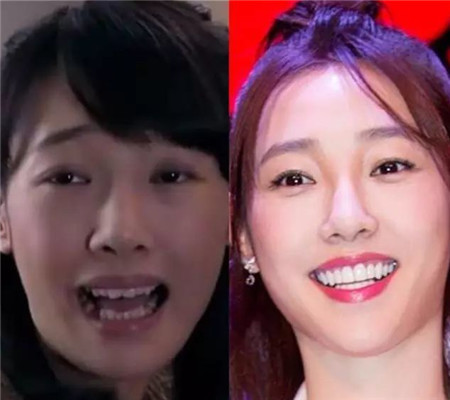 明星做烤瓷牙会做根管治疗吗,烤瓷牙的明星