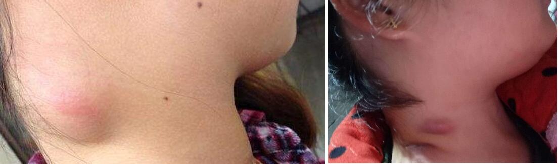 颈部淋巴结肿大要手术切除吗,颈部淋巴结肿大要手术切除活检吗