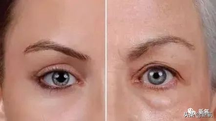 景甜修复之后的双眼皮是多宽,景甜修复后的双眼皮多宽