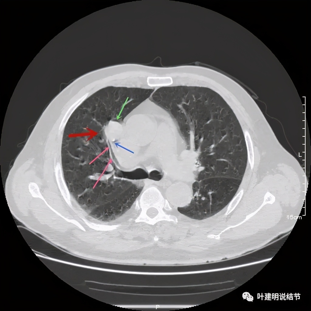 误诊报告图片,误诊案例及案例分析