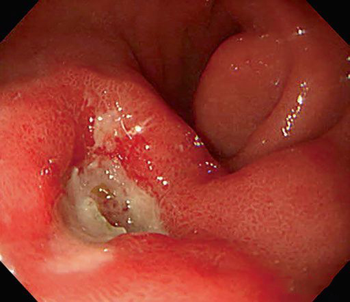 十二指肠球部霜斑溃疡有什么症状,十二指肠球部溃疡症状会后背疼吗