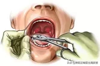拔牙矫正的利弊,拔牙有没有不痛苦的方法