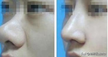 为什么长胖了鼻头也变大,鼻头大瘦下来会不会跟着变小