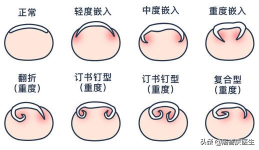 改掉啃手的习惯,拔肉刺引起甲沟炎