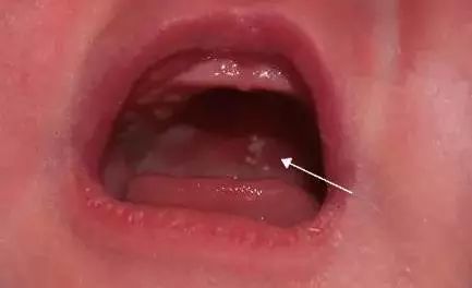 宝宝长牙齿和鹅口疮的区别,马牙与鹅口疮的区别及护理方法