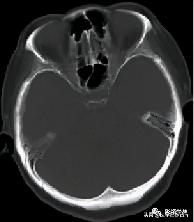 鞍区肿瘤做什么检查得出来,鞍区肿瘤的影像学鉴别