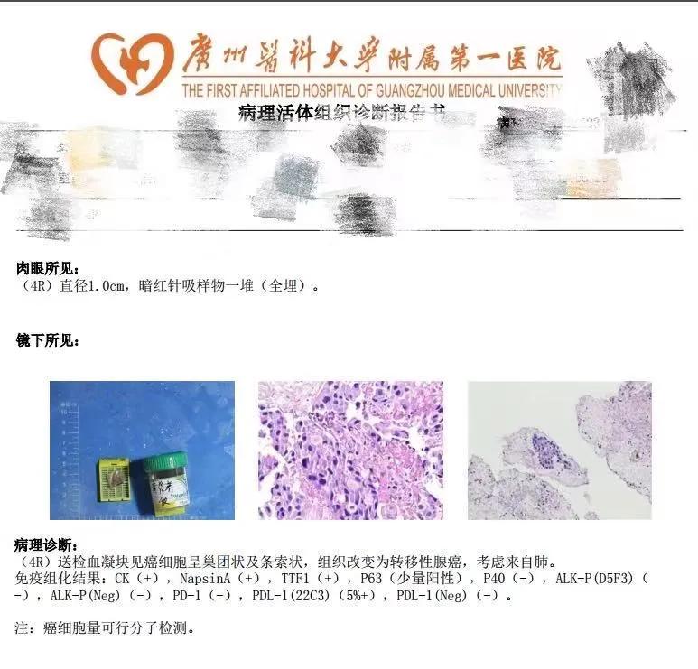 腰痛与肺癌有关吗,腰痛的厉害是得了肾癌吗