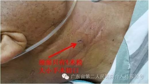 肝硬化时门静脉高压症形成的原因,肝硬化门静脉高压的症状原因